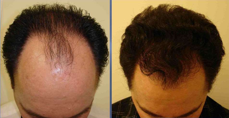FUE Hair Transplant - Dr. OBT-Best Plastic & Aesthetic Surgeon | Skin Care  Expert